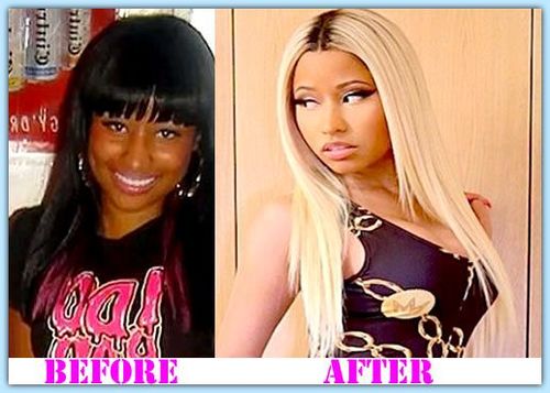 Nicki-Minaj-Plastic-Surgery-Before-and-After1